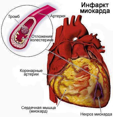 infarkt-miokarda