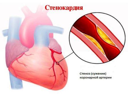 stenokardija
